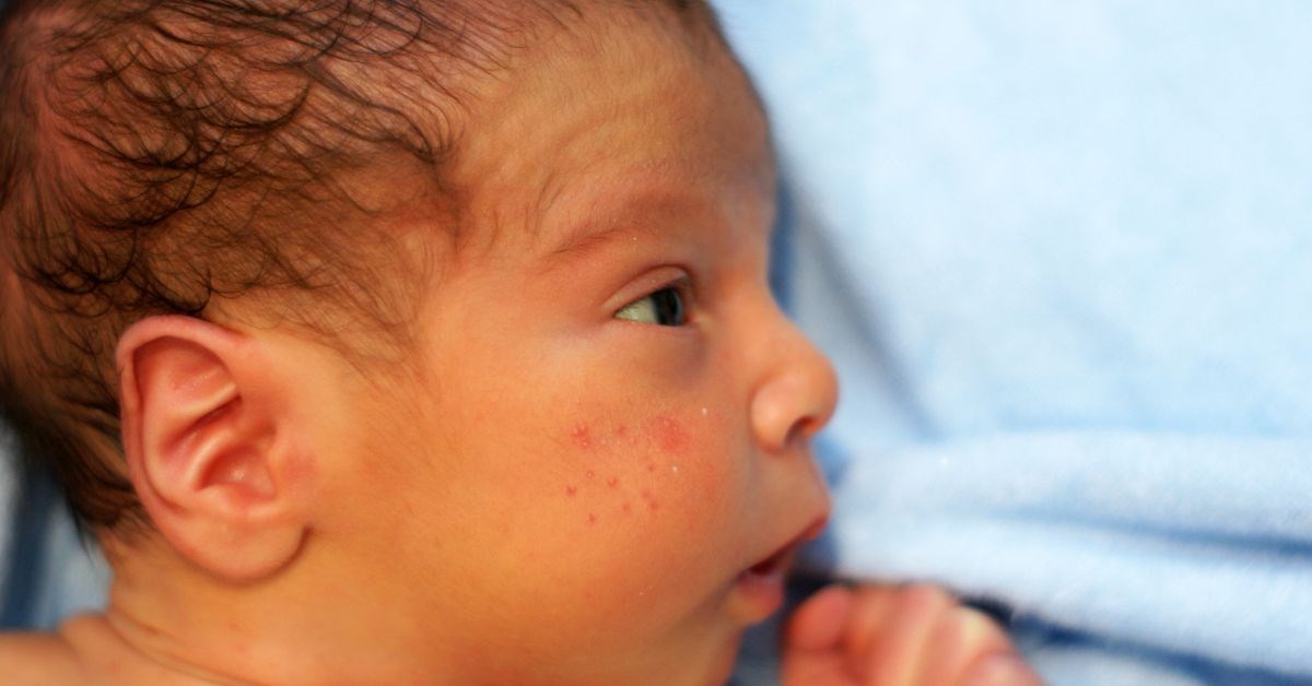 Nguyên nhân gây ra mụn sữa ở trẻ sơ sinh là gì?
