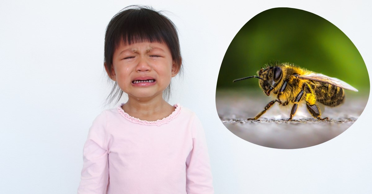 Hình ảnh về trẻ bị ong đốt sẽ giúp chúng ta hiểu rõ hơn về tình huống cấp cứu và phòng tránh sự cố này.