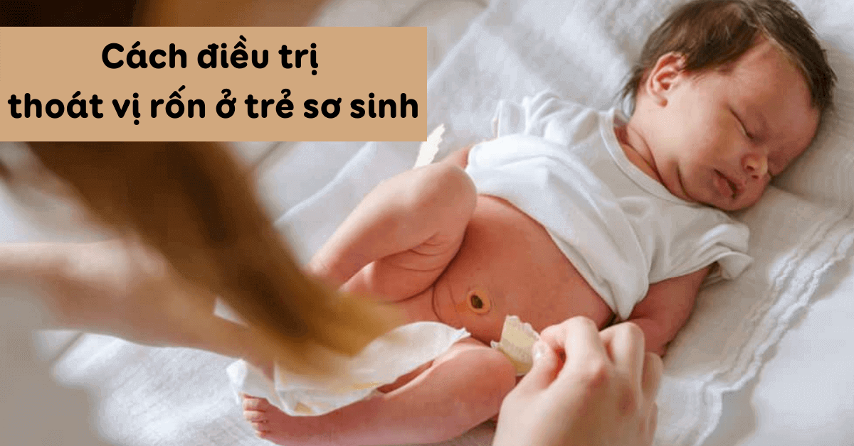 Cách điều trị thoát vị rốn ở trẻ sơ sinh hiệu quả