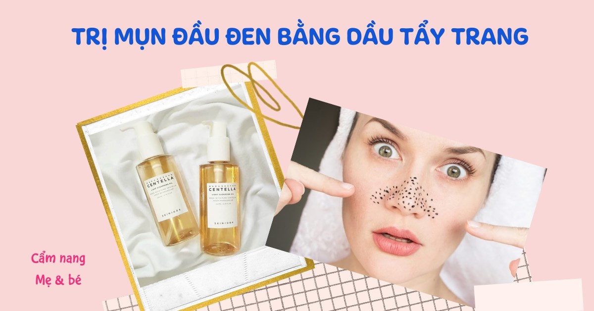 Dầu tẩy trang có tác dụng làm mờ vết thâm sau mụn không?

These questions cover various aspects of the keyword dầu tẩy trang cho da mụn such as its suitability for oily and acne-prone skin, its benefits for treating acne, how to use it properly, potential side effects, and its ability to unclog pores and reduce acne scars.
