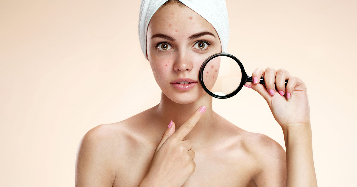 Mặt nổi mụn có phải dấu hiệu mang thai không? Làm sao để nhận biết?