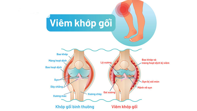 Hình ảnh so sánh khớp bị viêm và khớp bình thường Hình ảnh so sánh khớp bị viêm và khớp bình thường