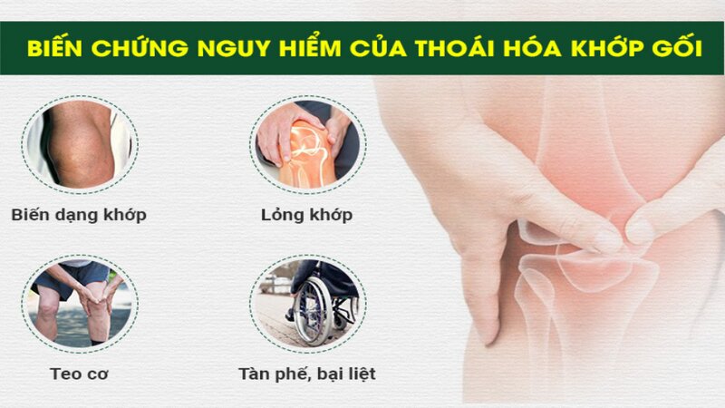 Các biến chứng nguy hiểm của thoái hóa khớp. Các biến chứng nguy hiểm của thoái hóa khớp.