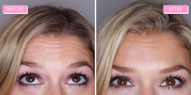 Ảnh so sánh trước và sau (Before and After)