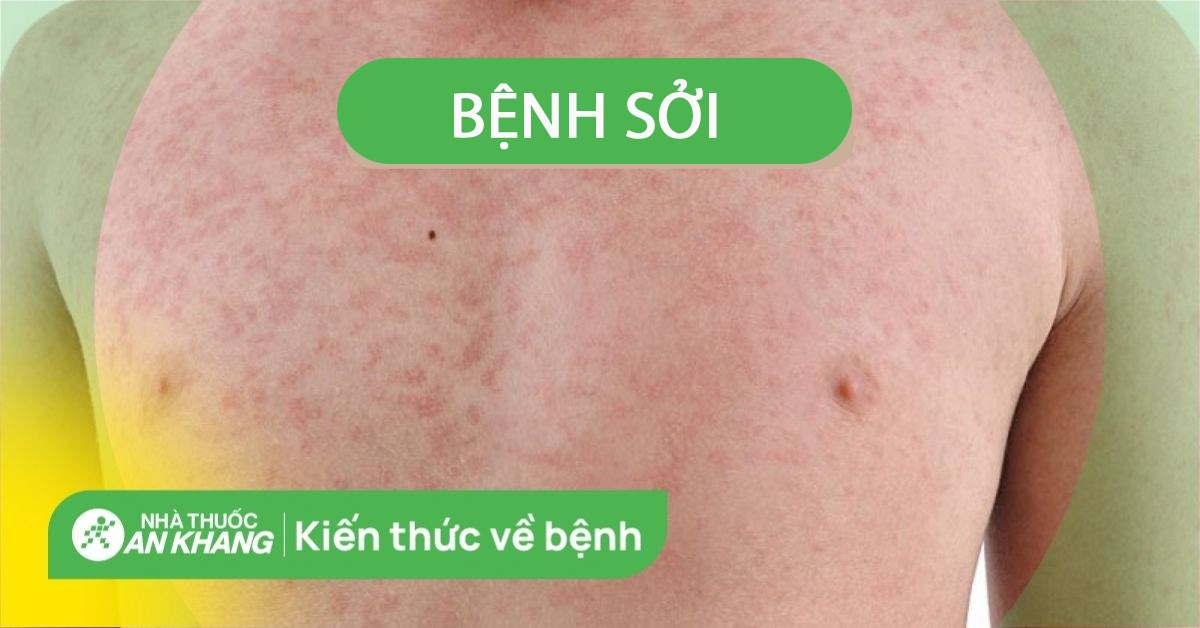 Bệnh sởi: Nguyên nhân, triệu chứng và cách phòng ngừa hiệu quả