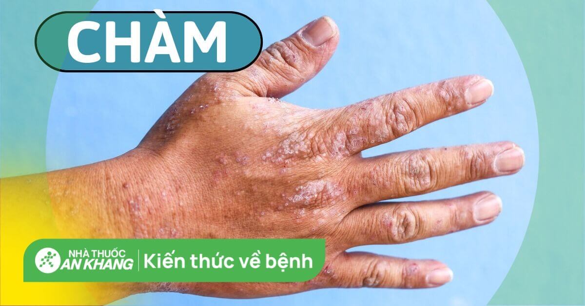 Cách nhận biết dấu hiệu bệnh chàm da và biện pháp phòng tránh