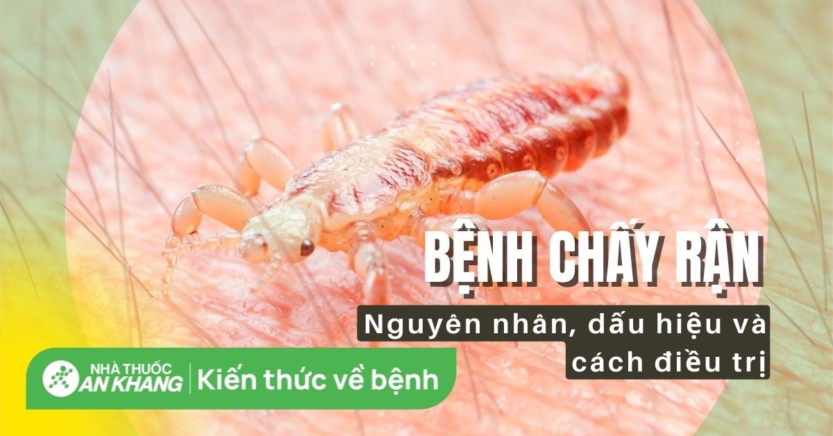 Chấy rận: Đặc điểm, dấu hiệu, nguyên nhân, cách điều trị