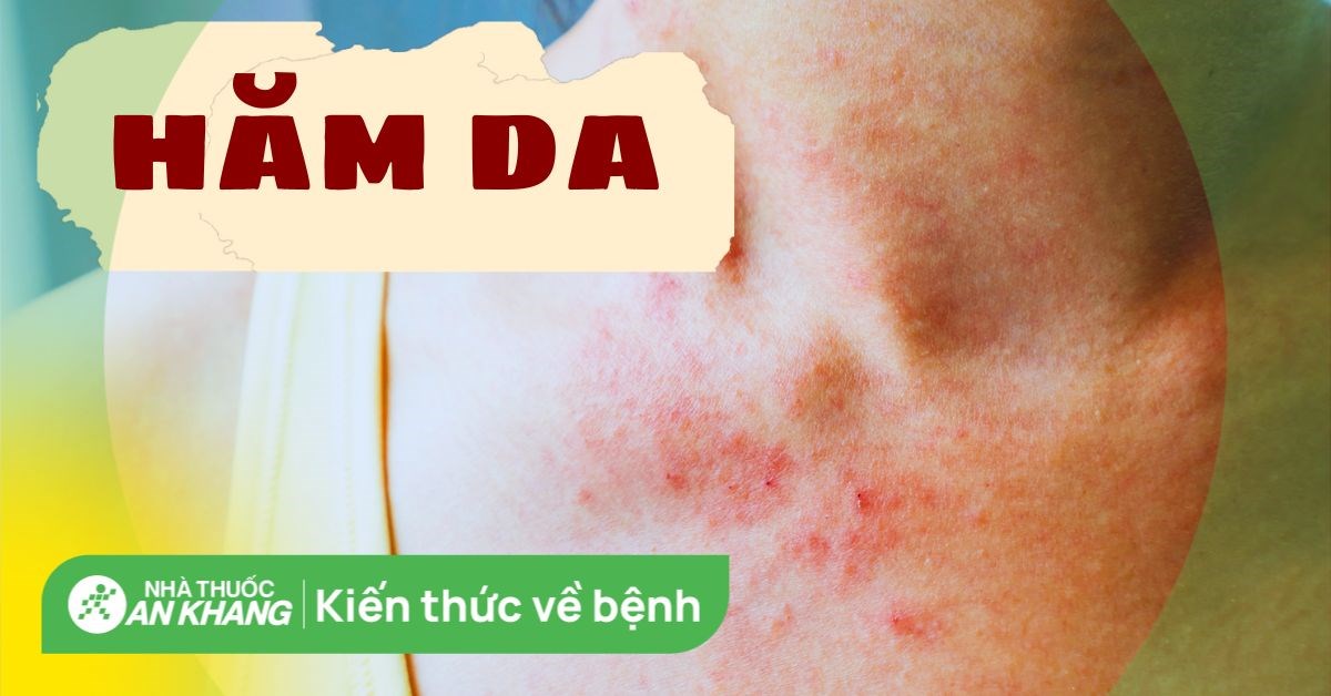 Hăm da: Nguyên nhân, dấu hiệu, cách xử trí và phòng ngừa