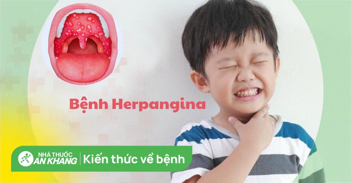 Bệnh herpangina: Nguyên nhân, triệu chứng, điều trị và phòng ngừa