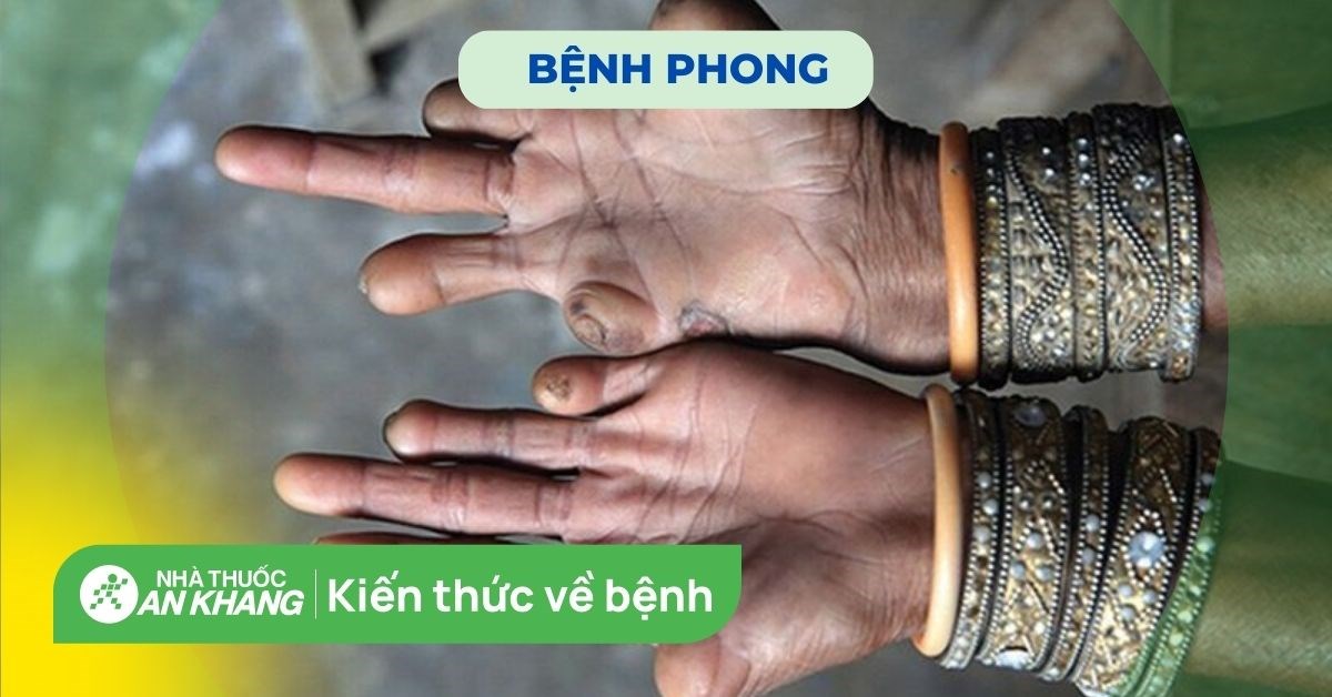 Bệnh phong hủi có thể chữa khỏi hay không?
