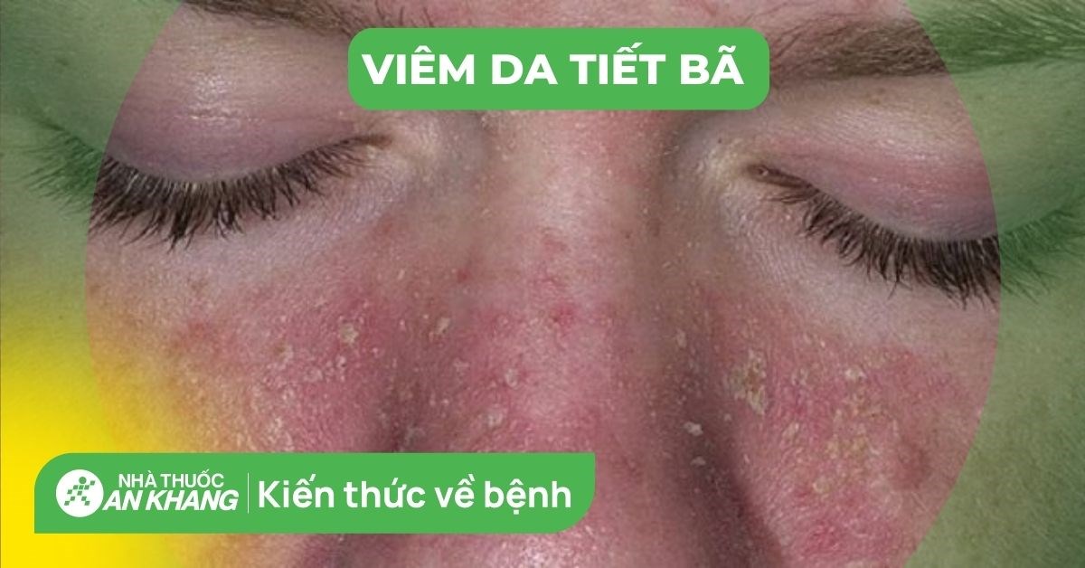 Viêm da tiết bã: Nguyên nhân, triệu chứng, cách điều trị bệnh