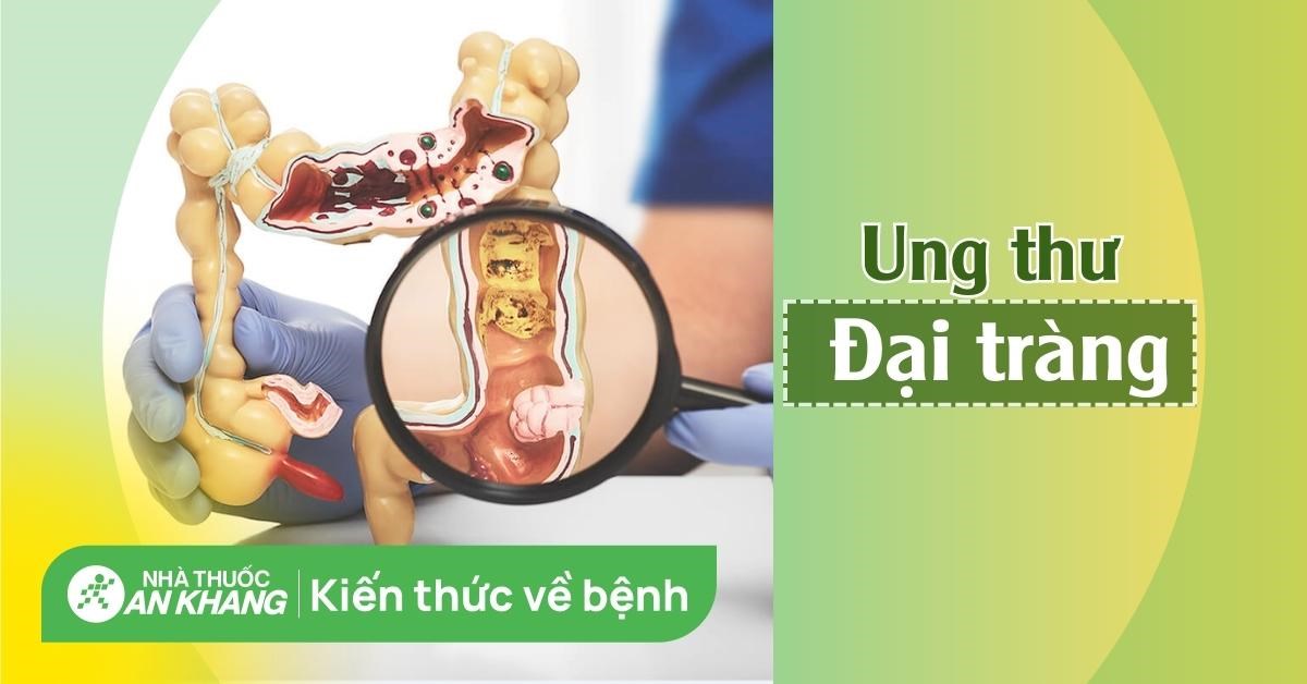 Ung thư đại tràng: Dấu hiệu nhận biết sớm và cách điều trị
