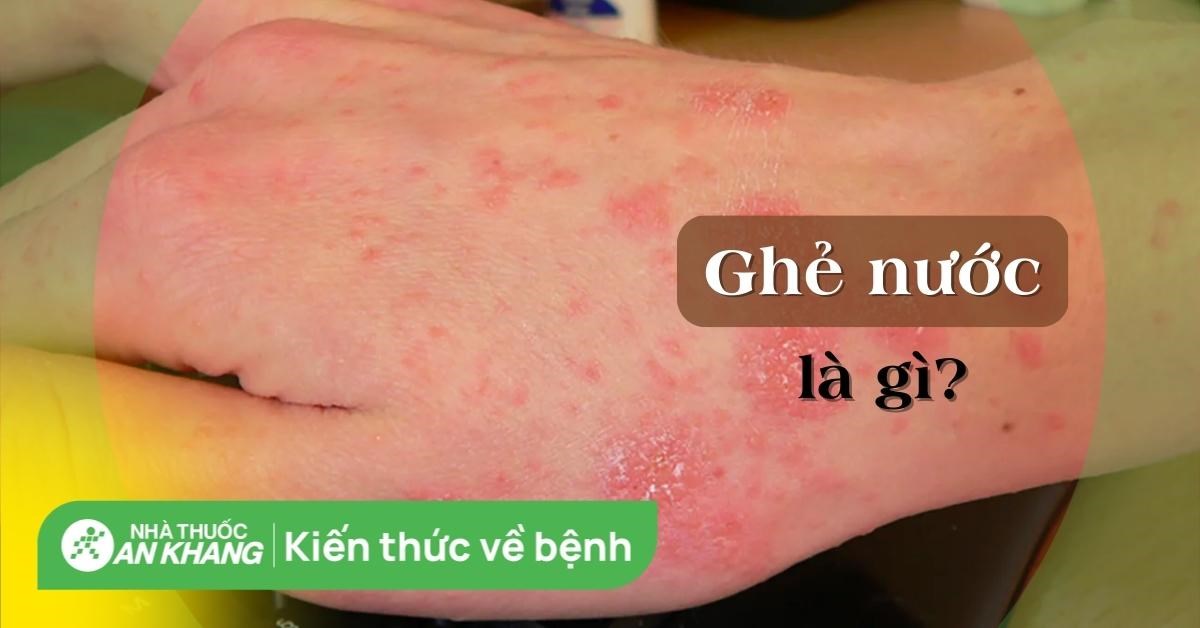 Bệnh ghẻ nước: Nguyên nhân, triệu chứng và cách trị DỨT ĐIỂM