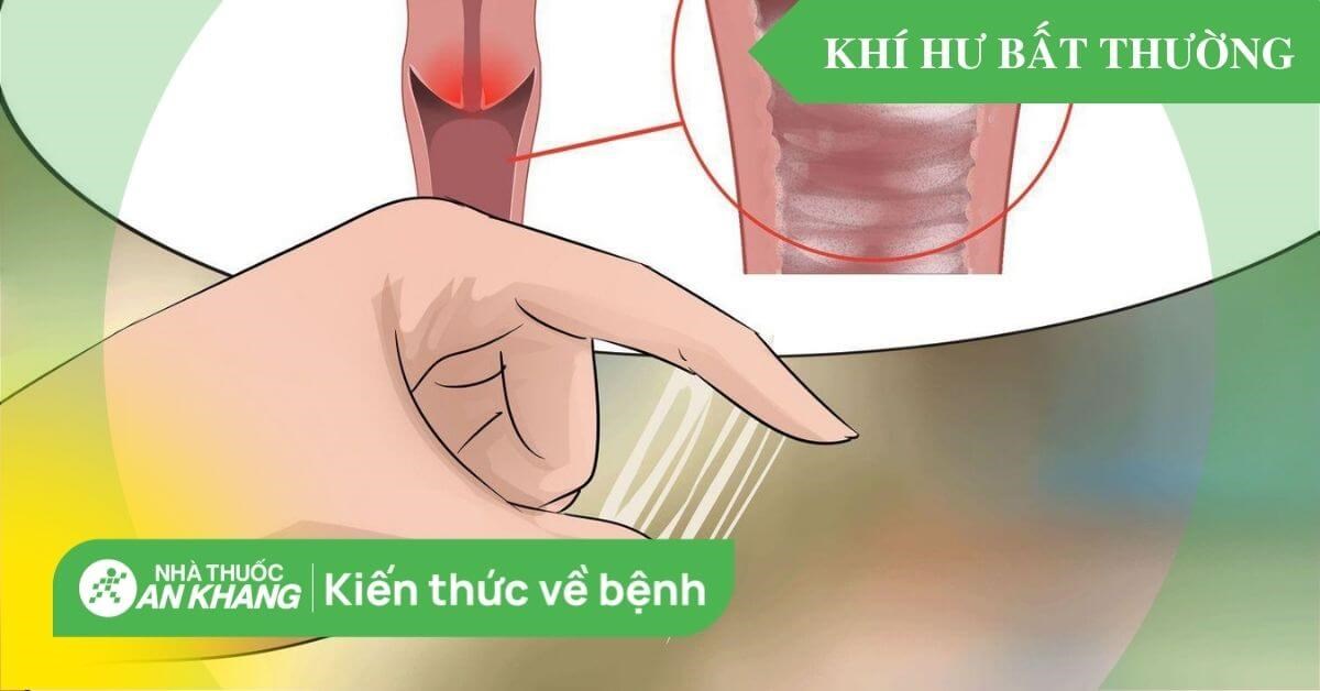 Bệnh huyết trắng là gì? Triệu chứng, nguyên nhân và điều trị
