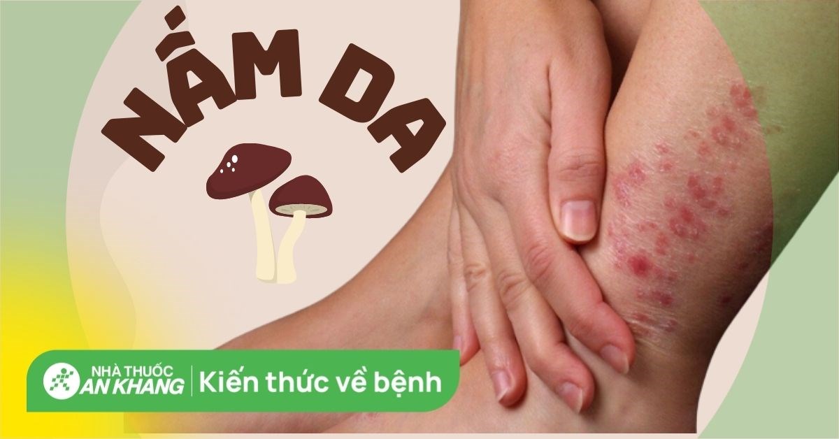 Bệnh nấm da là gì? Nguyên nhân, triệu chứng và cách điều trị