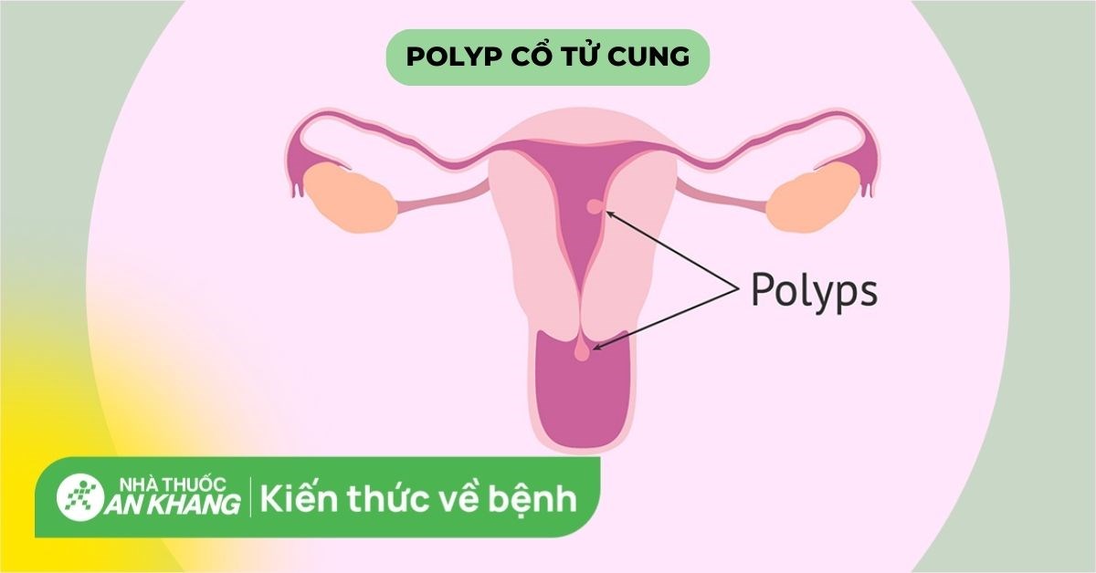 Phương pháp chẩn đoán bệnh phụ khoa polyp là gì?
