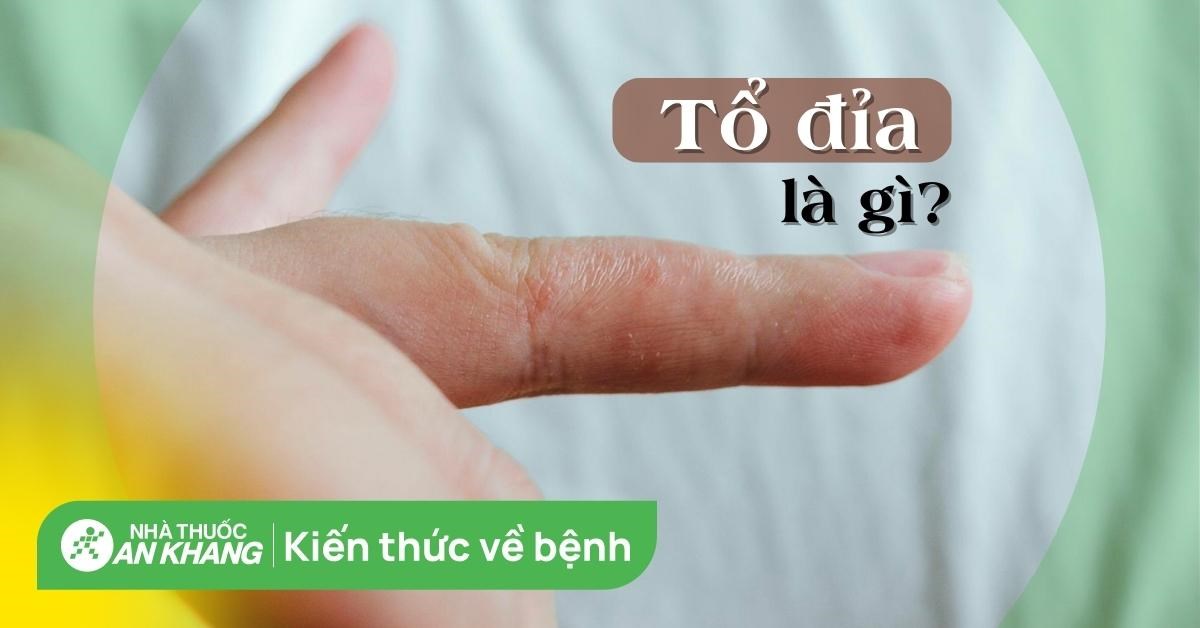Bệnh tổ đỉa có lây không? Nguyên nhân và cách điều trị tổ đỉa