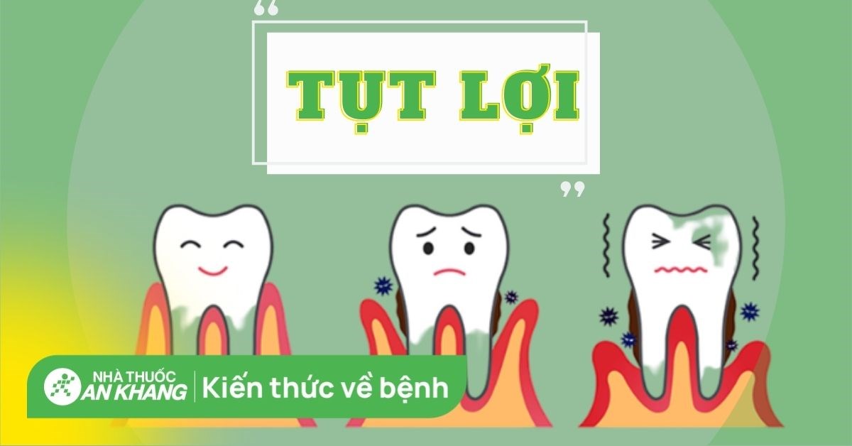 Tụt lợi: Nguyên nhân, phương pháp điều trị và cách chăm sóc răng miệng