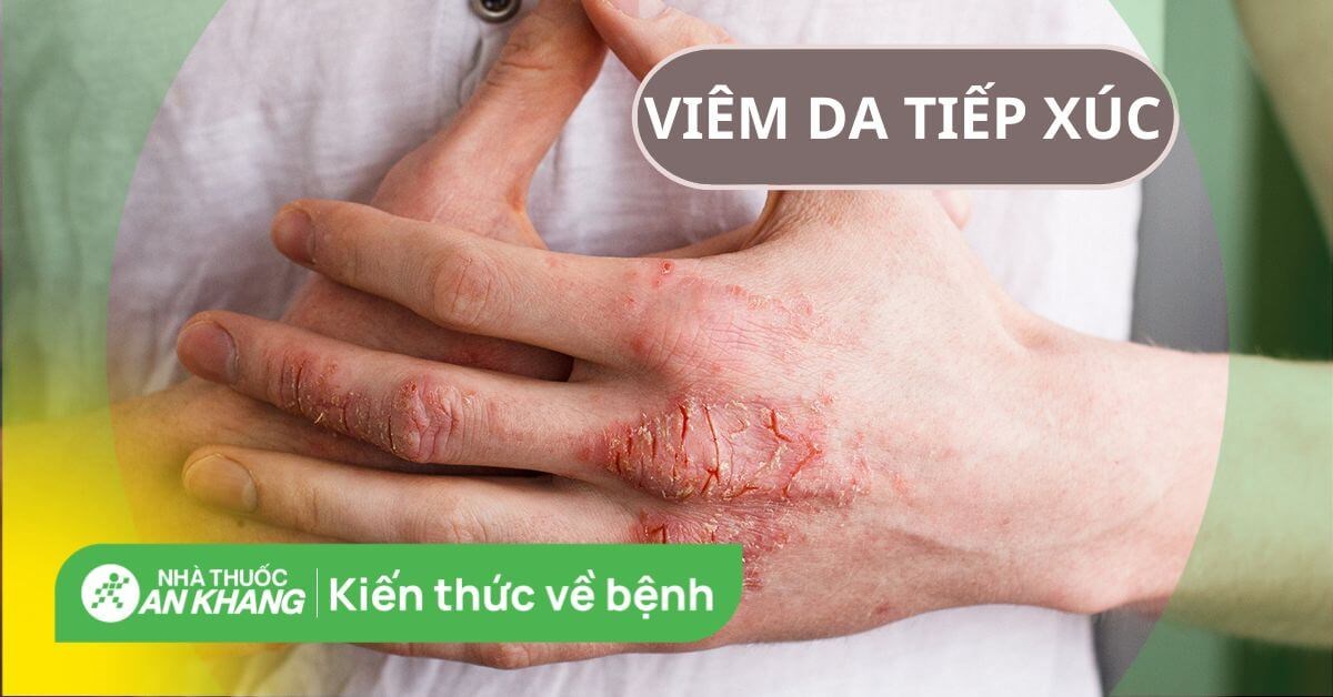 Thời gian cần sử dụng kem bôi viêm da tiếp xúc để đạt hiệu quả tốt nhất?
