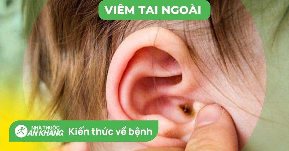 Các yếu tố nguy cơ khác ngoài bơi lội và tắm biển có thể gây viêm tai ngoài là gì?