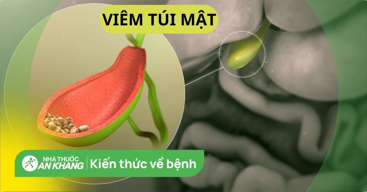 What are the symptoms of viêm túi mật?
